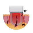 Me _elosDiagram RF and IPL.jpg