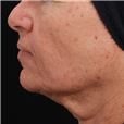 Before/After