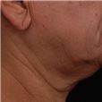 pic 4_age 54_after.jpg