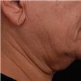 pic 4_age 54_before.jpg