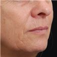 pic 7_age 57 before.jpg