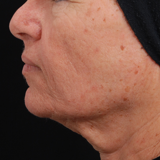 pic 1_age 54_after.jpg
