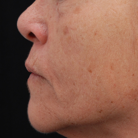 pic 5_age 63 after.jpg