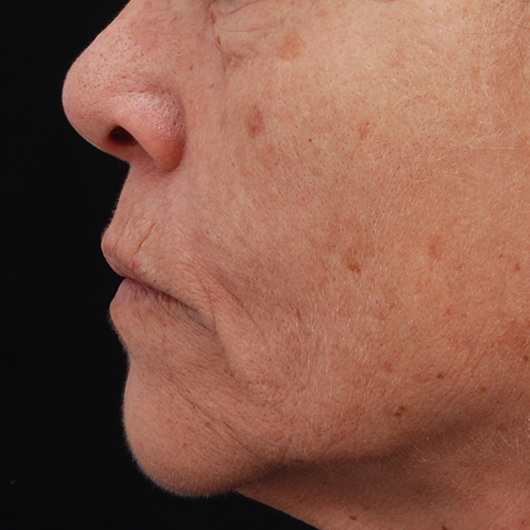 pic 5_age 63 before.jpg