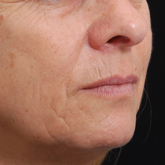 pic 7_age 57 before.jpg
